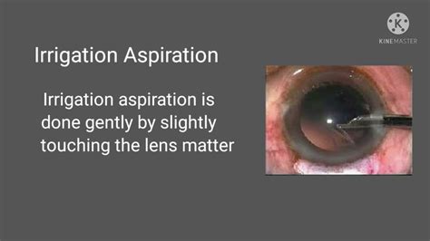 Extracapsular Cataract Surgery Steps Youtube