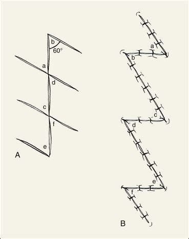 Z-Plasty | Clinical Gate