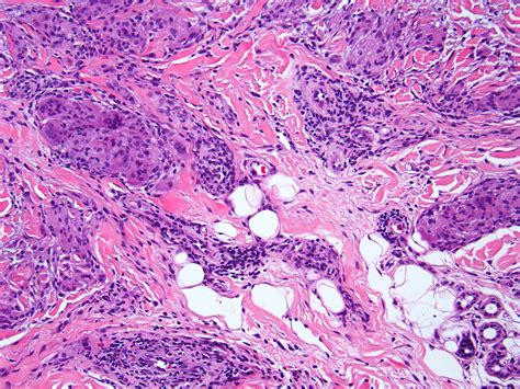 Granuloma Annulare Histology