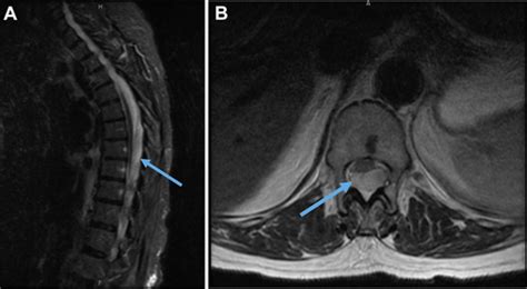 A Mysterious Bleed A Case Of Spontaneous Spinal Epidural Hematoma