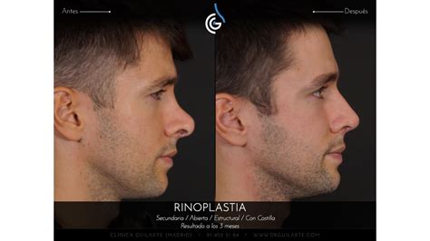 Caso Foto Rinoplastia Drguilarte