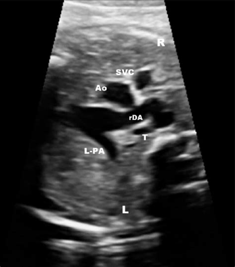 The Fetal Echocardiographic Image The Transverse View Of The Right