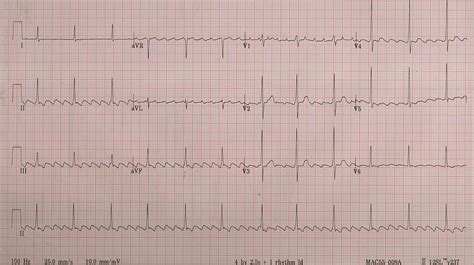 Atrial Flutter — Diagnosis Management And Treatment Intechopen