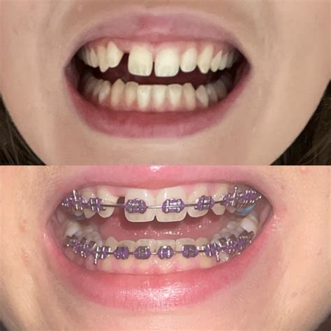 Two Month Progress R Braces