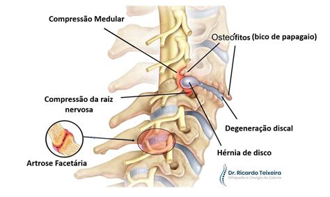 Total Imagem Cirurgia De Bico De Papagaio Na Cervical Br