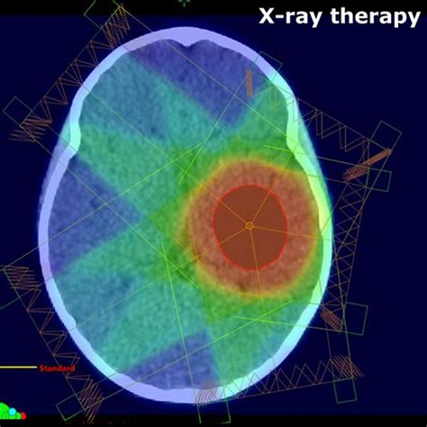 Is Proton Therapy The Silver Bullet For Children With Brain Cancer