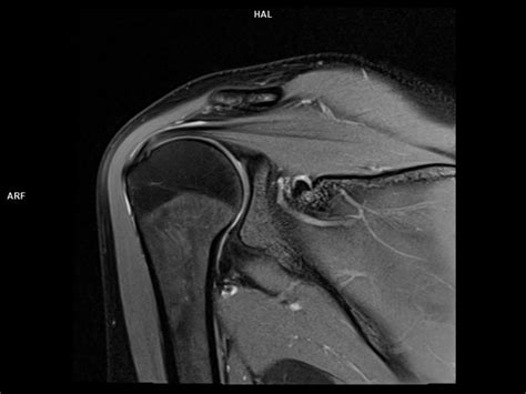 Coronal Pd Fs Magnetom Lumina Siemens Healthineers Usa