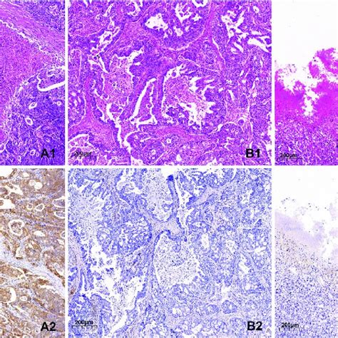 A Tumour Substantive Necrosis And The Expression Of PD L1 Of In GC