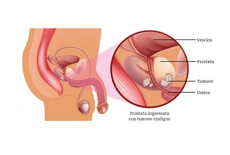 Rimozione Del Tumore Del Cancro Alla Vescica