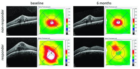 OCT images of DME patients obtained with Heidelberg Spectralis at ...