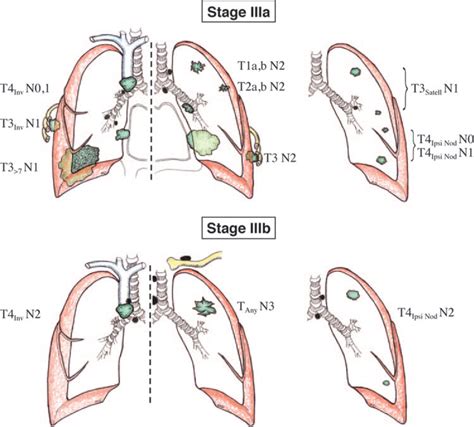 The New Lung Cancer Staging System Chest