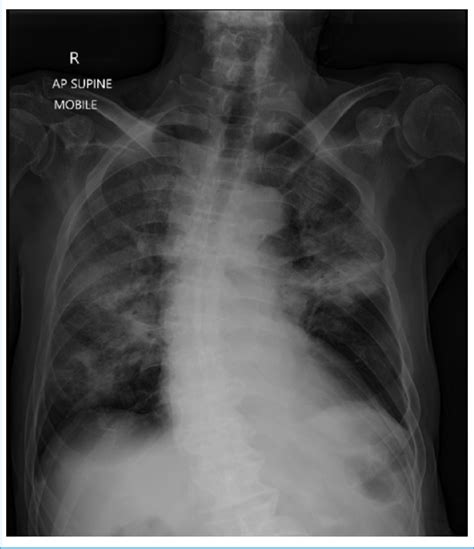 Chest Radiograph On Admission Showing Bilateral Diffuse Groundglass Download Scientific Diagram