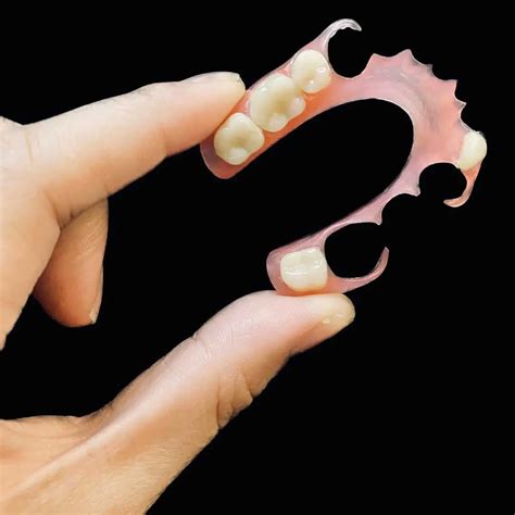 Metal partial vs flexible partial denture choices. | New Smile Dentures 