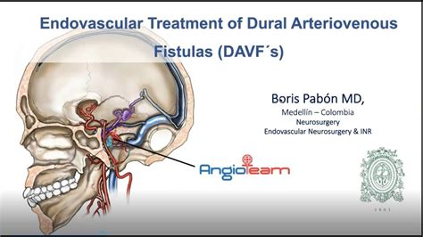 Fistulas Durales Cerebrales Diagnostico Y Manejo YouTube