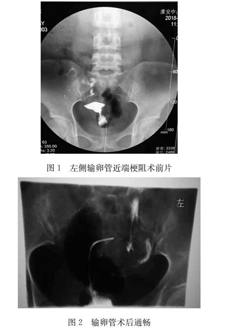 输卵管介入再通术治疗输卵管阻塞性不孕症的疗效观察 参考网