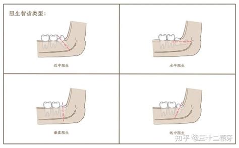 我的智齿该不该拔呢？ 知乎