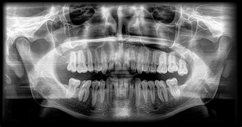 Radiologia Stomatologiczna Pantomogram Rtg Elstom Zamo