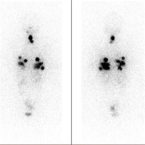 First Posttreatment Whole Body Scan Showing Uptake Foci Suggestive Of