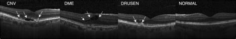 Oct Categories Cnv Dme Drusen And Normal Download Scientific Diagram