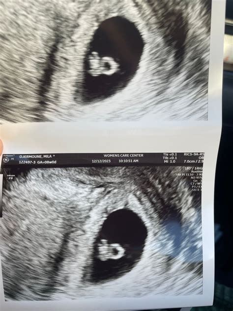 Week Ultrasounds July Babies Forums What To Expect