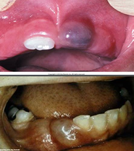 Odontogenic And Non Odontogenic Cysts Flashcards Quizlet