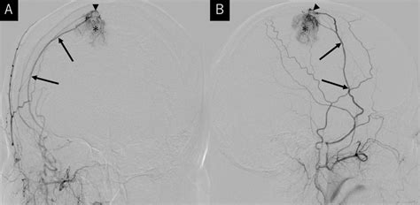 A B Right External Carotid Angiography Anteroposterior A And Download Scientific Diagram