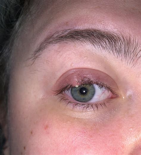 Stye, mid burst! : r/popping