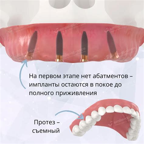 Виды адаптационных протезов при all-on-4 и all-on-6 и цены на их ...