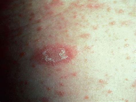 Pityriasis Rosea Causes Symptoms And Treatment Tua Saúde