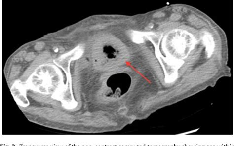 Bilateral Emphysematous Pyelonephritis Semantic Scholar