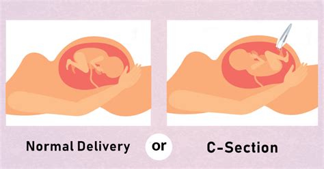 Natural Delivery Vs Cesarean Section Larexcare