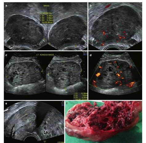 Granulosa cell tumour in two patients...with thick endometrium 18mm Delivering A Baby ...