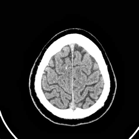 Ultimate Radiology : Multiple Cavernomas in Brain