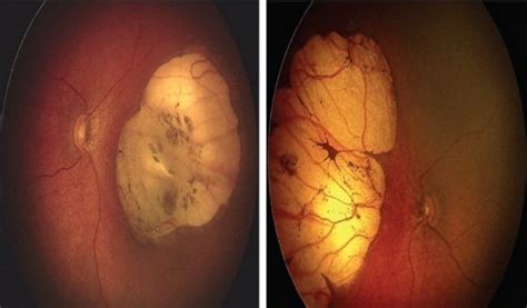 Zika Virus And The Eye Marianas Eye Institute