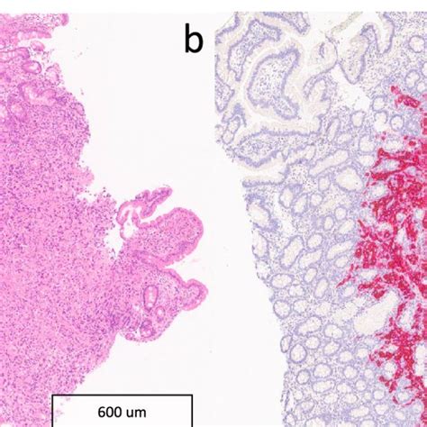 A Histological Section Of Native Duodenal Mucosa Infiltrated By