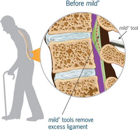 Download Before Mild - Spinal Stenosis Mild Procedure - ClipartKey