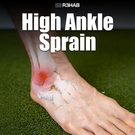 High Ankle Sprain E3 Rehab