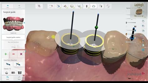 3shape Implant Studio 2020 Detailed Workflow Youtube