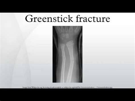 Greenstick Fracture Youtube