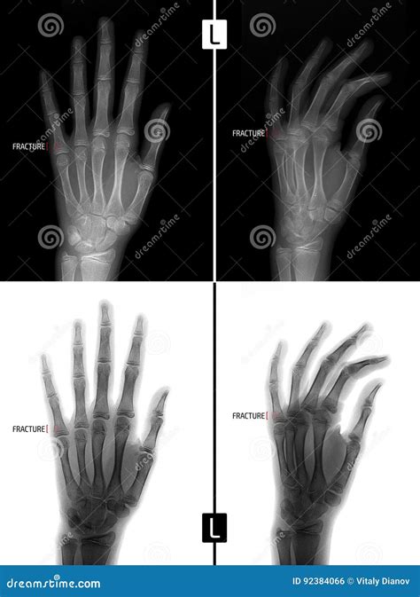 X Ray Of The Hand Shows The Fracture Of The Base Of The Proximal