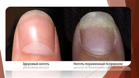 Болезни и дистрофии ногтевого органа» - презентация онлайн