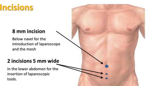 The Health Website Inguinal Hernia