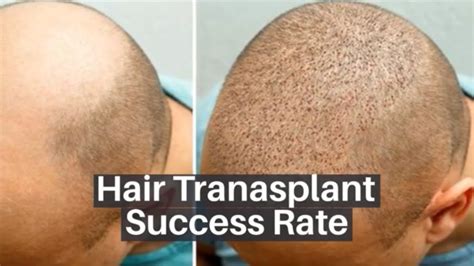 Hair Transplant Success Rate How Successful Are Hair Transplants Lyfboat Youtube