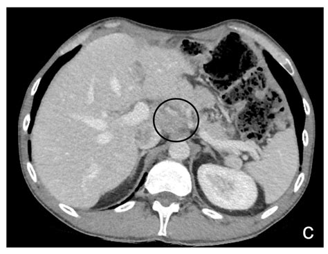 Diagnostics Free Full Text Peritoneal Carcinosis What The