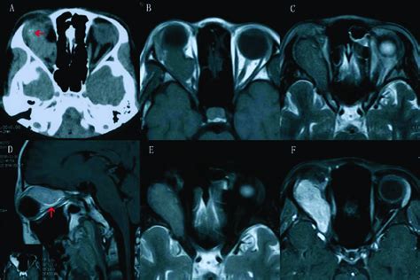 A Computed Tomography Shows That Mesenchymal Chondrosarcoma In The