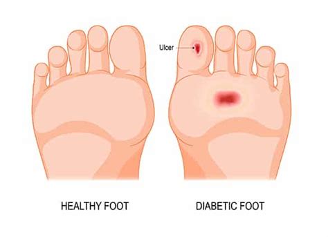 Diabetic Foot Ulcers Brisbane Brisbane North Podiatry Clinic