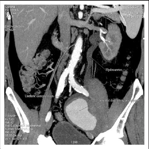 Figure From A Rare Case Of Large Isolated Internal Iliac Artery