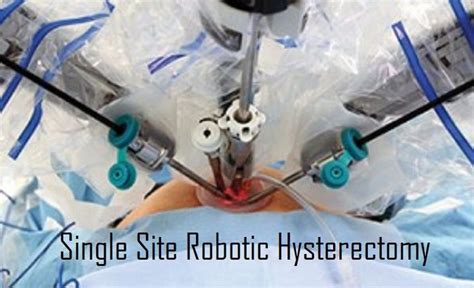 Port Position Of Various Robotic Genaecological Surgeries