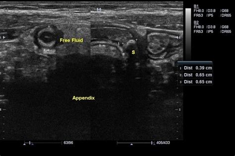 Appendicolith Ultrasound