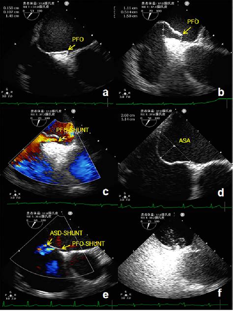 Saline Contrast Echocardiography For The Detection Of, 56% OFF